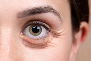 Eye bag Removal Surgery - Hong Plastic Surgery