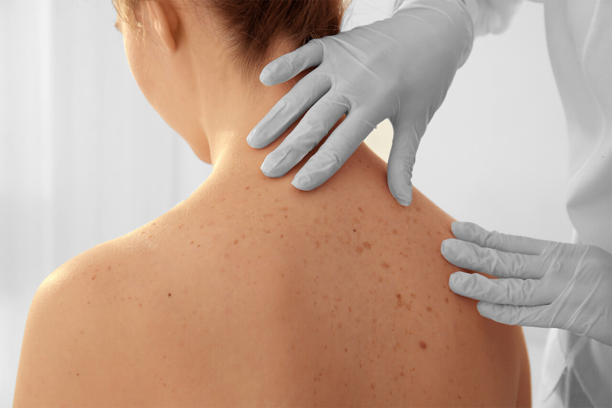 Skin Cancer Diagnosis & Treatment - Hong Plastic Surgery