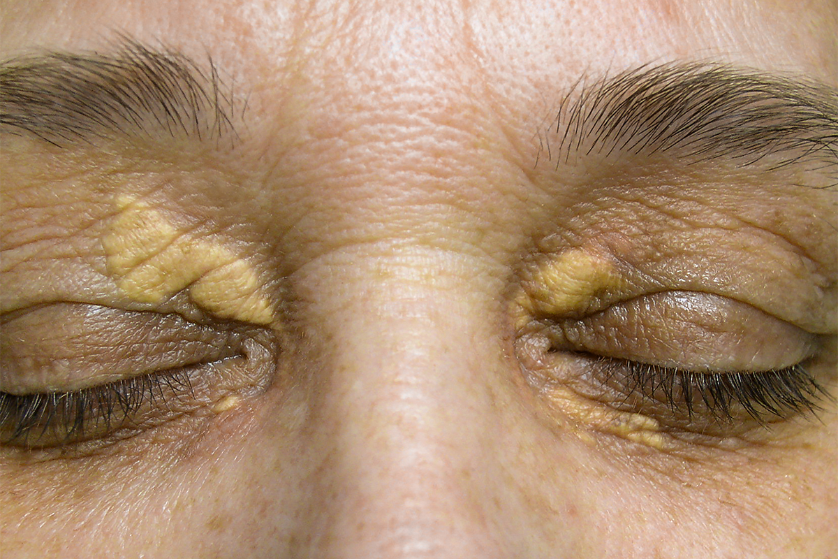 Xnthelasma Eyelids Treatment - Hong Plastic Surgery